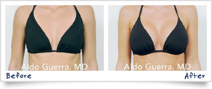 We use the Keller Funnel® in all of our silicone breast implant cases.