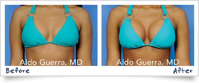 Breast Augmentation Before After Photo - Case