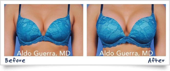 Breast Augmentation Bikini Before After Photo